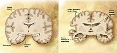 230px-Alzheimer's_disease_brain_comparison