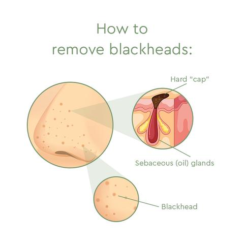 beauty-blackheads-chart